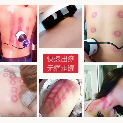 艾灸拔罐一體罐與電動(dòng)刮痧儀 傳統(tǒng)養(yǎng)生與現(xiàn)代科技的完美融合